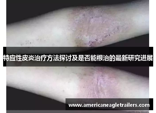 特应性皮炎治疗方法探讨及是否能根治的最新研究进展